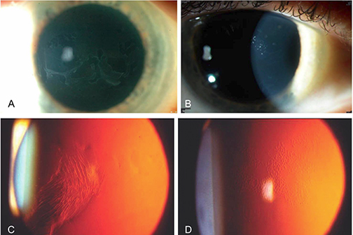 corneal dystrophies